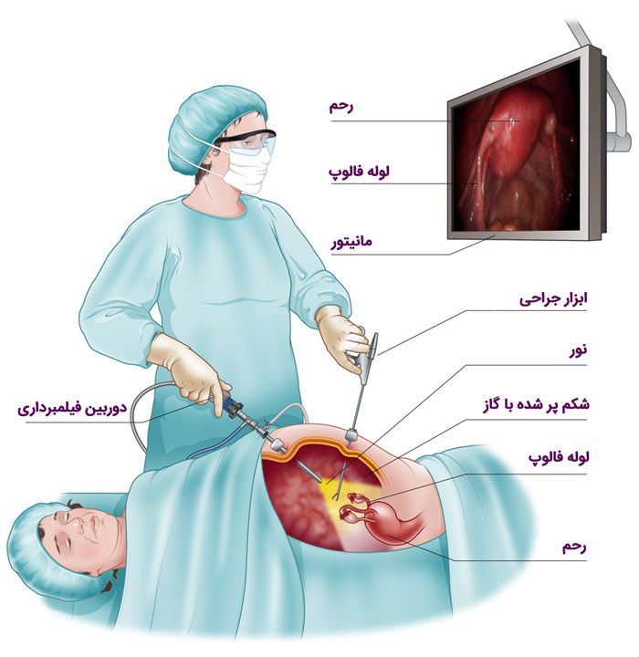 لاپاروسکوپی